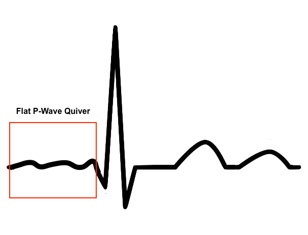 Atrial Fibrillation (A-Fib) ECG - ProMedCert