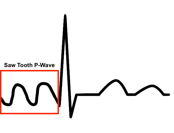 Atrial Flutter (A-Flutter) - ProMedCert