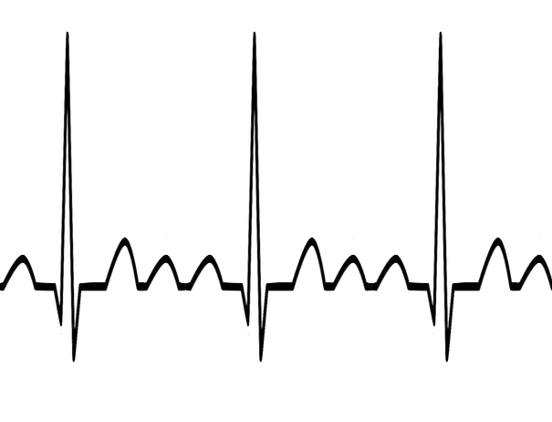 Supraventricular Tachycardia (SVT) - ProMedCert