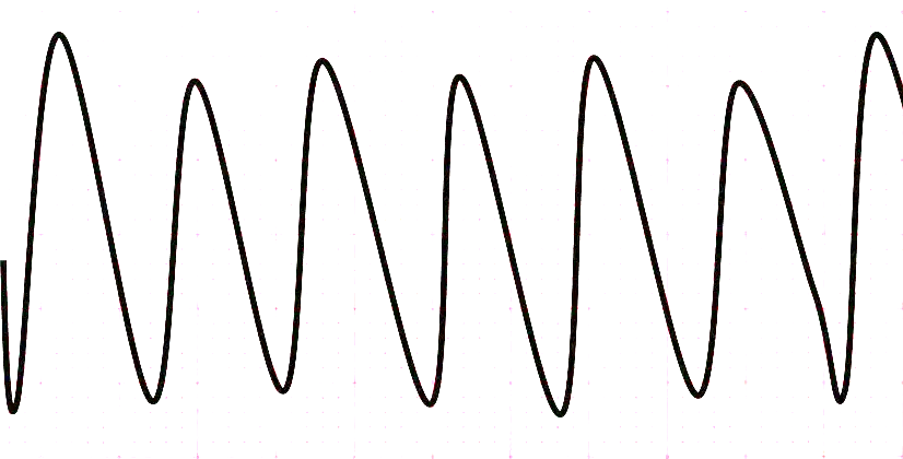 Ventricular Tachycardia ECG - ProMedCert