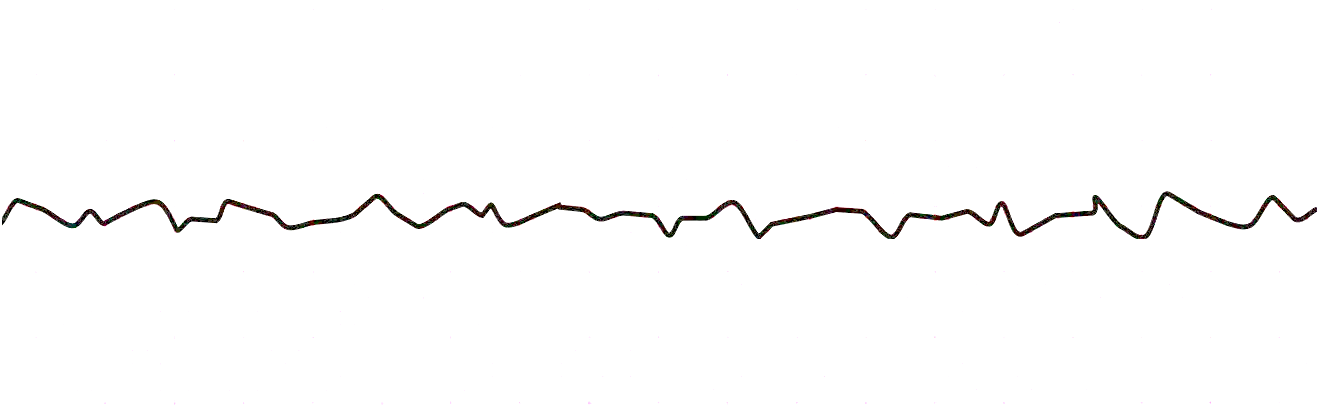 Ventricular Fibrillation ECG - ProMedCert